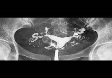 Retrospective analysis of HSG in primary infertility