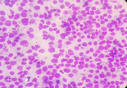 Case report of a rare case of Non-hodgkin Lymphoma presenting as sternal mass