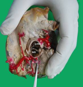 Anatomical Study of the Variations of Sinuatrial and Atrioventricular Nodal Arteries in Human Heart