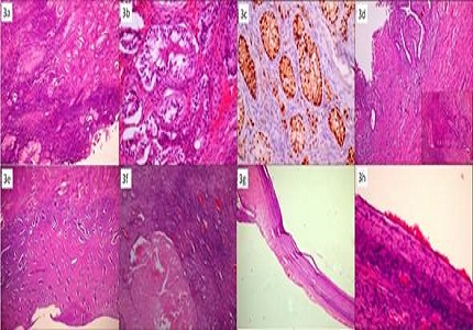46, XXovotesticular disorder of sex development with serous cystadenomas of the ovary