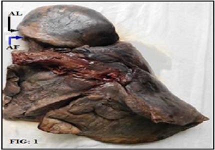 A cadaveric study on accessory lobes of lungs and their bronchial branching pattern