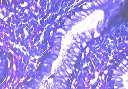 Incidence of Helicobacter Pylori in upper gastrointestinal lesion