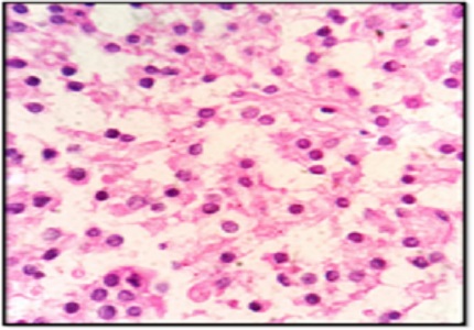 Solid pseudopapillary neoplasms-experience from a tertiary care centre
