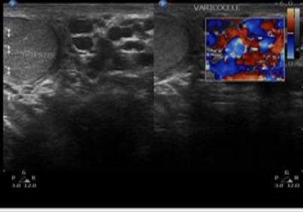 Role of trans rectal and scrotal ultra sonography in male infertility