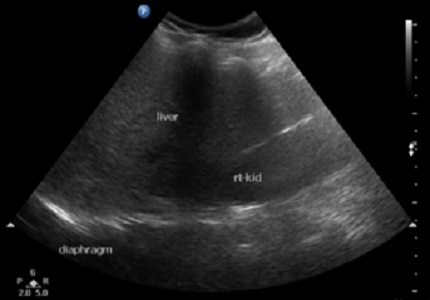 Detection and quantification of liver fat with MRIT1 dixon sequence in patients with hepatic steatosis and it’s comparison with USG