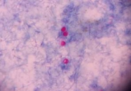 Study of opportunistic intestinal parasitic infections in people living with HIVand their relationship with immune status