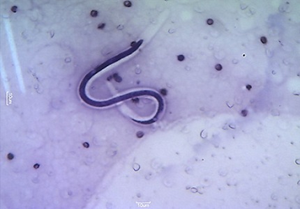 Unanticipated cytodiagnosis of filariasis: A Study of 16 cases
