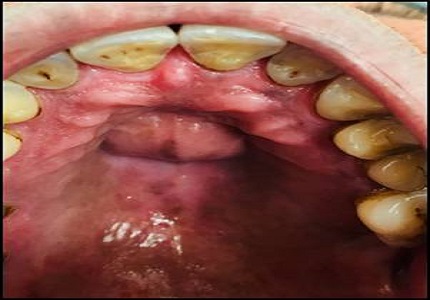 Aggressive nasopalatine duct cyst with nasal involvement