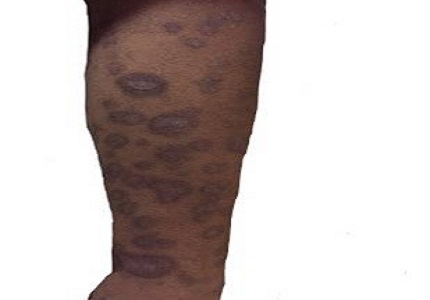 A case report on phenobarbitone induced stevens-johnson syndrome: an alarming hypersensitivity reaction
