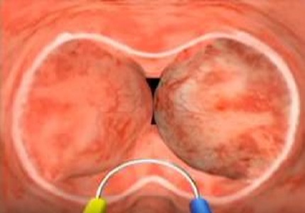 Safety and efficacy of Transurethral Bipolar Enucleation of prostate (TUBE) in BPH