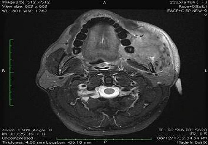 Role of MRI in evaluation of oral cavity cancers from central India